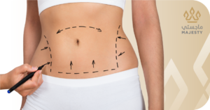 العناية بعد عملية شد البطن