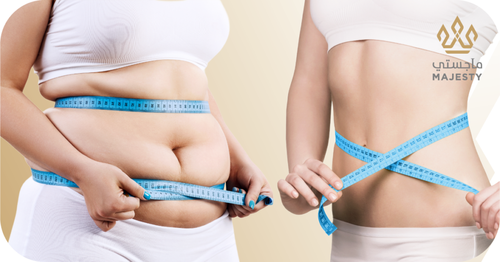 نحت الجسم بالترددات الراديوية: الحل الأمثل لتشكيل جسدك