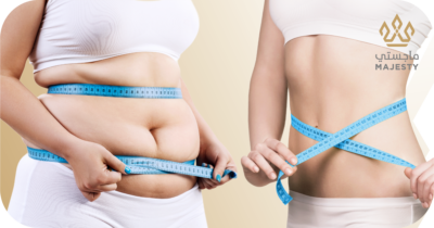 نحت الجسم بالترددات الراديوية: الحل الأمثل لتشكيل جسدك