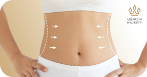 ما هو نحت الجسم بالترددات الراديوية؟