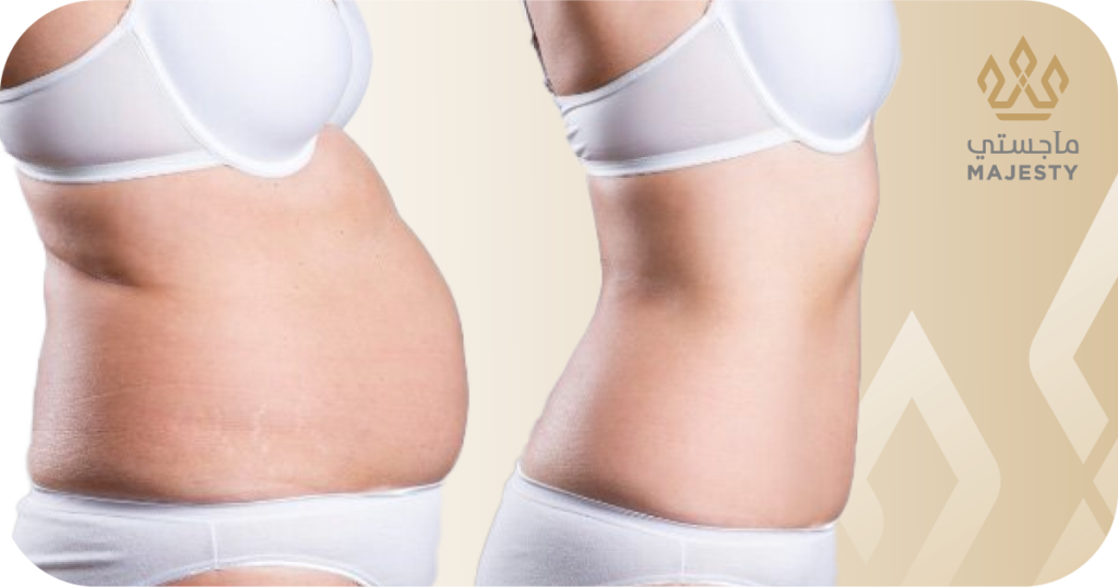 مدة التعافي بعد عملية شد البطن: إرشادات لتحقيق أفضل النتائج