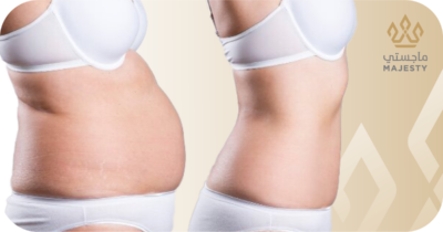 مدة التعافي بعد عملية شد البطن: إرشادات لتحقيق أفضل النتائج