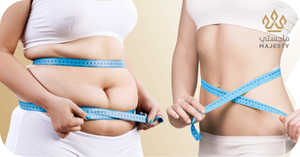 شد البطن بعد التكميم: دليلك الشامل