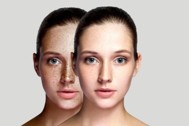 Skin Pigmentation