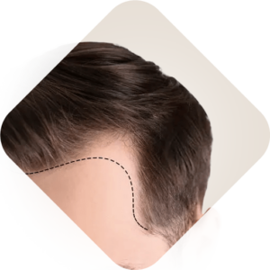 زراعة الشعر