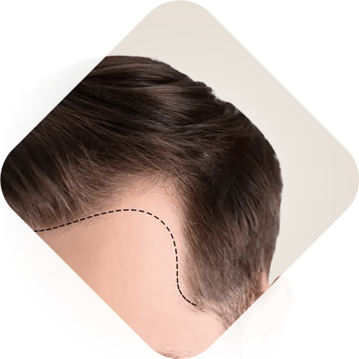 زراعة الشعر