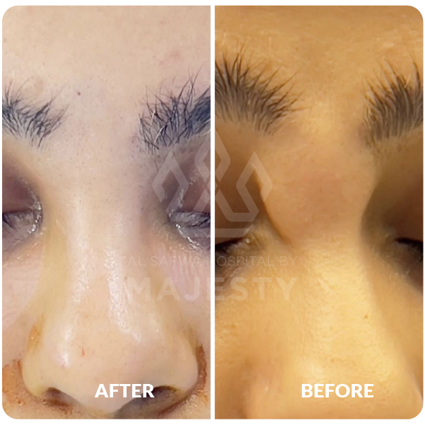 تجميل الأنف