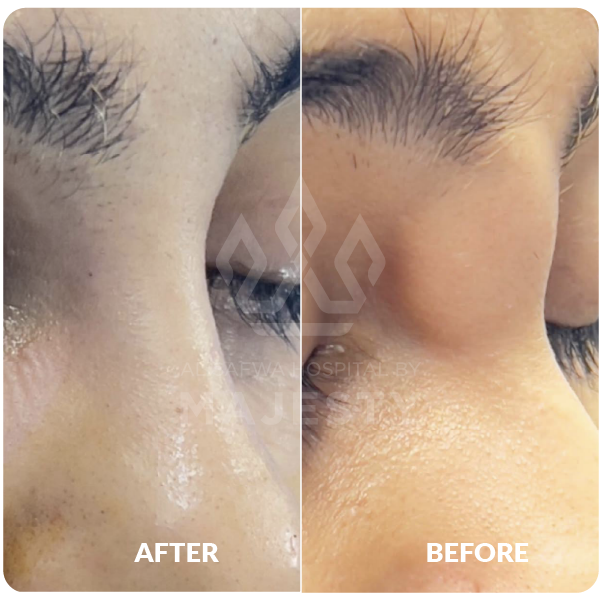 تجميل الأنف