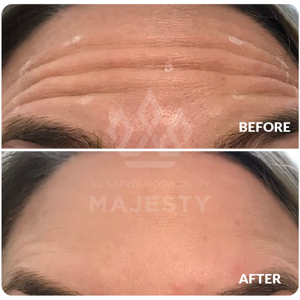 بوتكس الجبهة