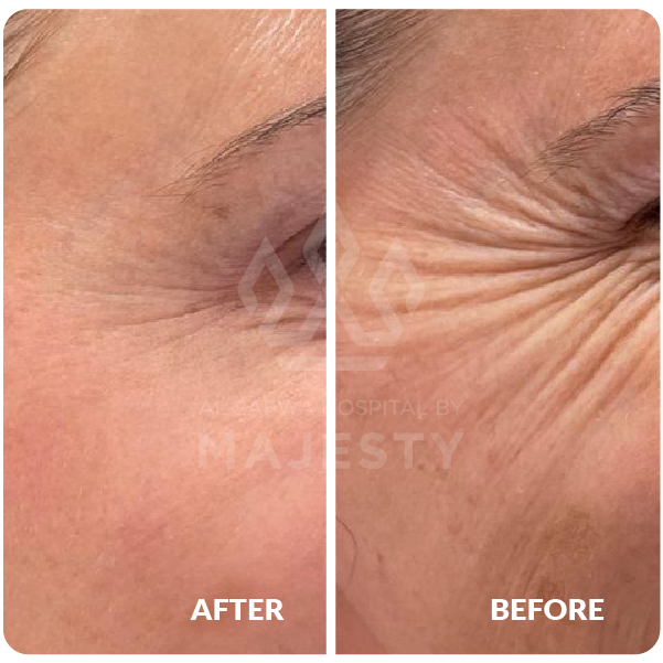 بوتكس تجاعيد حول العين