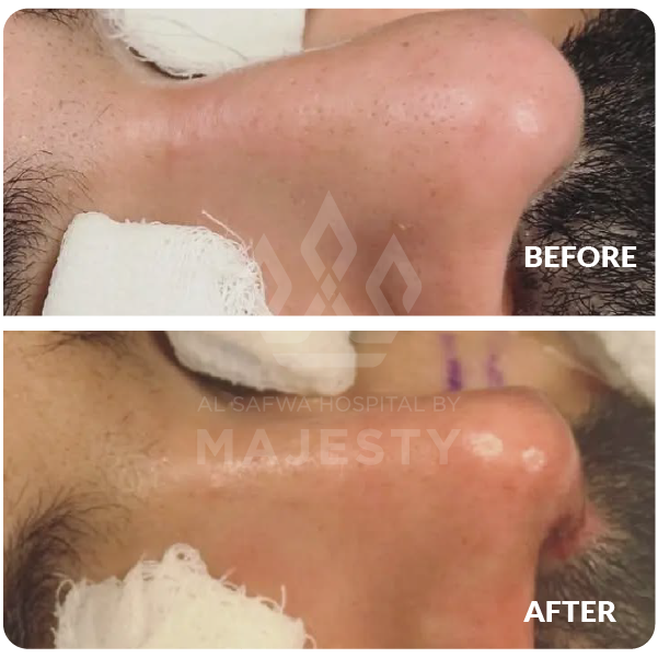 تجميل الأنف 1