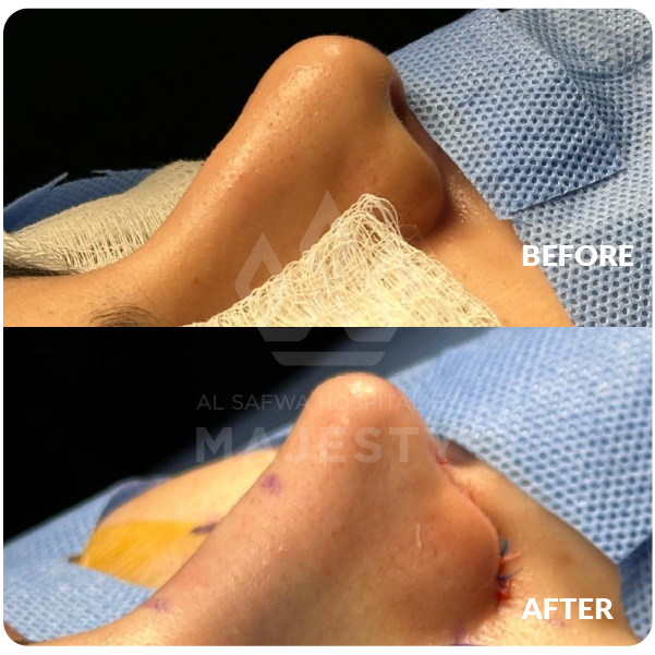 تجميل الانف 2