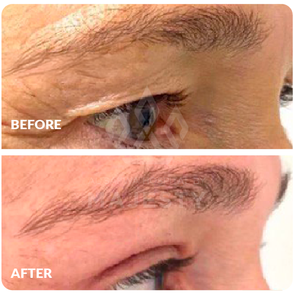 تجميل الجفون العلوية