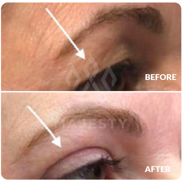 تجميل الجفون العلوية