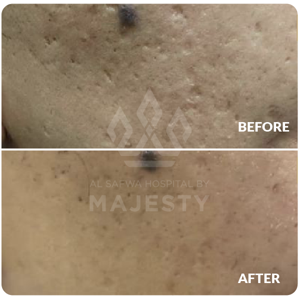 تقطيع الندبات