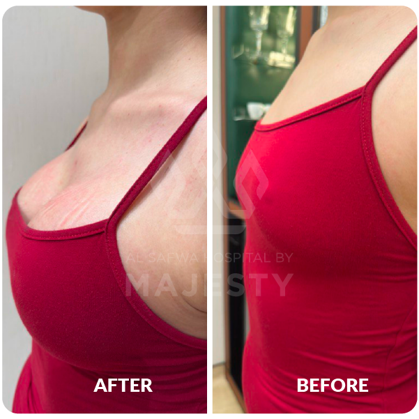 تكبير الصدر بحشوات السيليكون