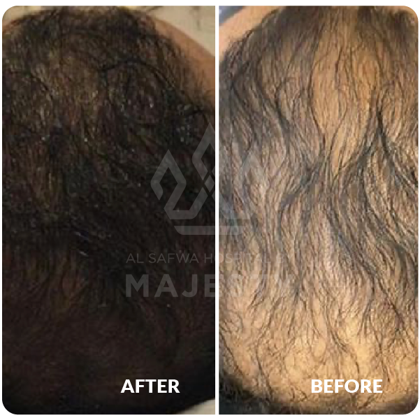 حقن الخلايا الجذعية للشعر