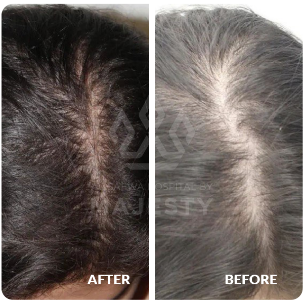 حقن الخلايا الجذعية للشعر