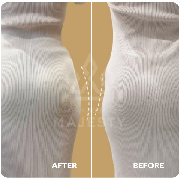 حقن الخفسات بالفيلر