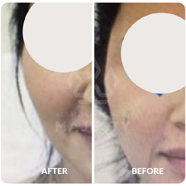 حقن النانو فات لكل الوجه