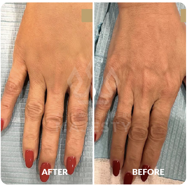 حقن الراديس لليدين