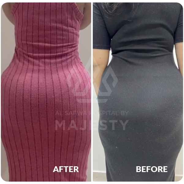 حقن المؤخرة