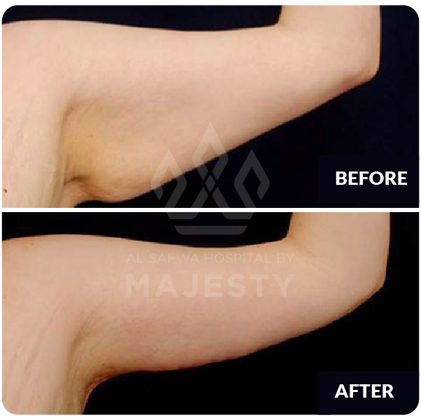 شد الذراعين