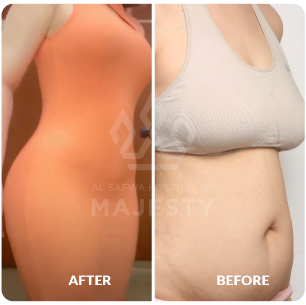 شد و تكبير الصدر، شـد البطن