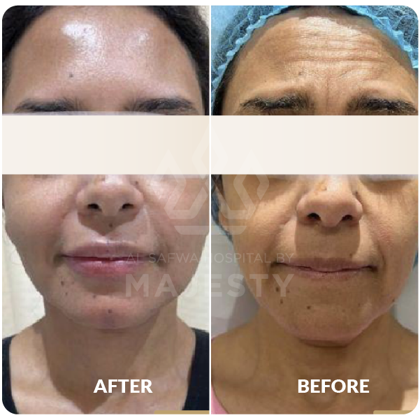 شد الوجه والرقبة مع حقن الدهون بالوجه