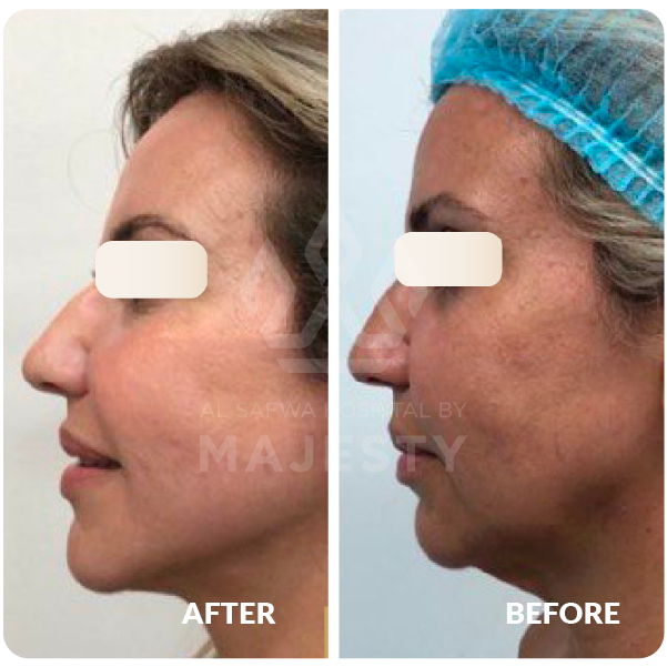 شد الوجه والرقية