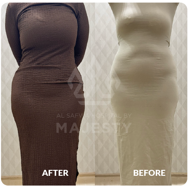 عمليات شد الجسم