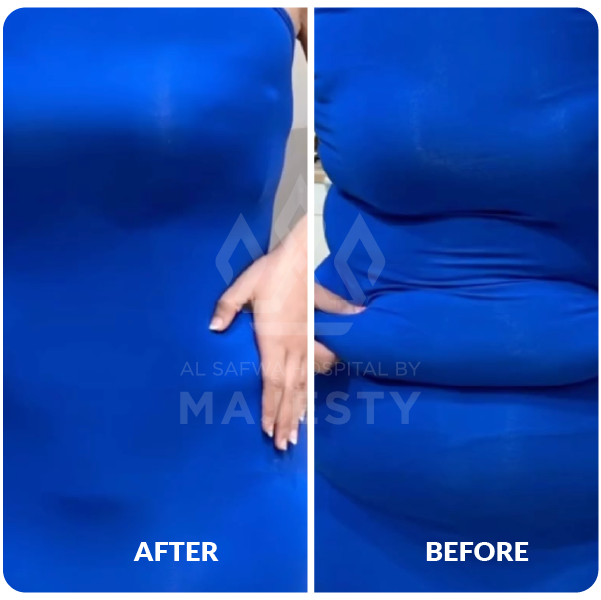 شد حزامي للبطن