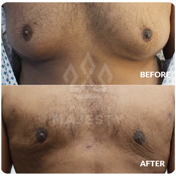 علاج التثدي