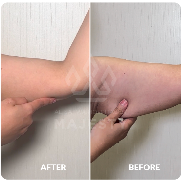 شد الذراعين