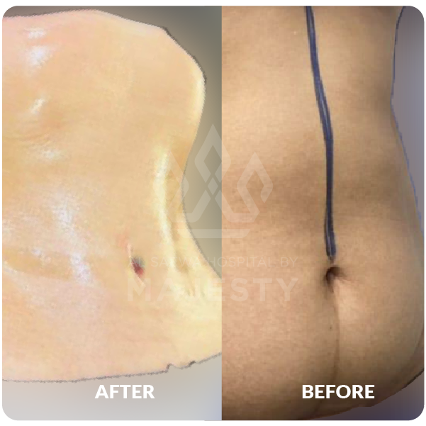 شفط وشد البطن