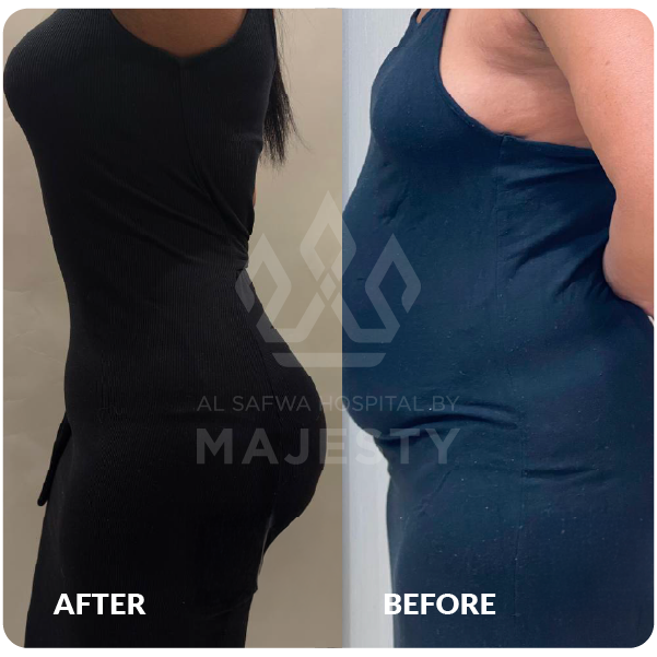 شفط الخواصر