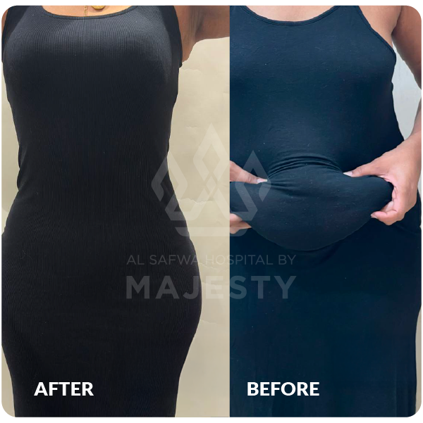 شفط وشد البطن
