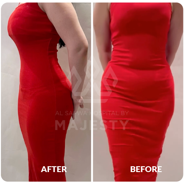 شد الجسم، شفط الدهون