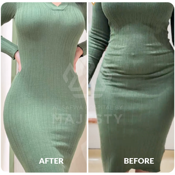 شفـــط الجسم 360