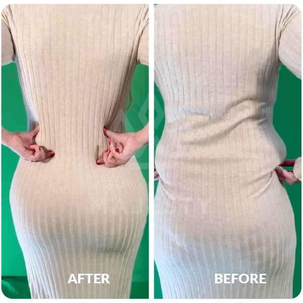 شفـــط دهون الظهر، حقن المؤخرة