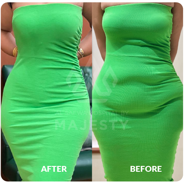 الشد الحزامي