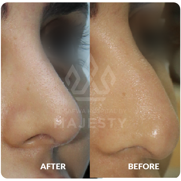 عملية تجميل الأنف