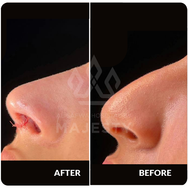 تجميل الأنف