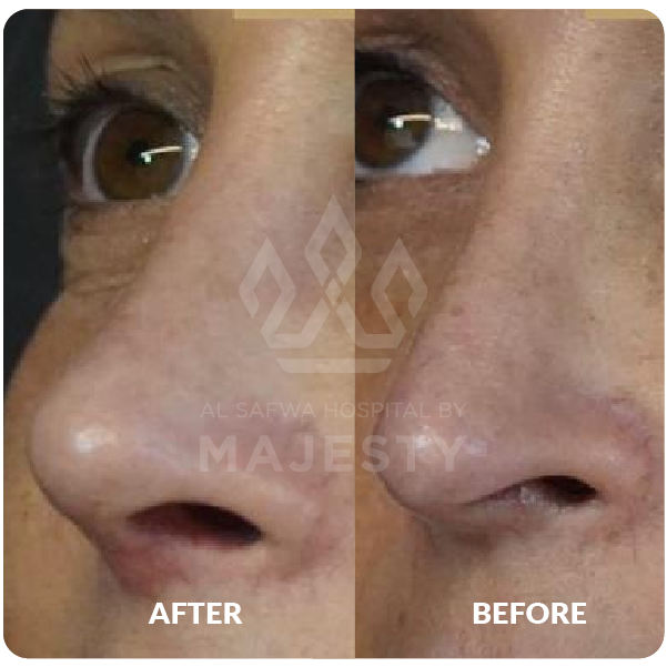 تجميل الأنف