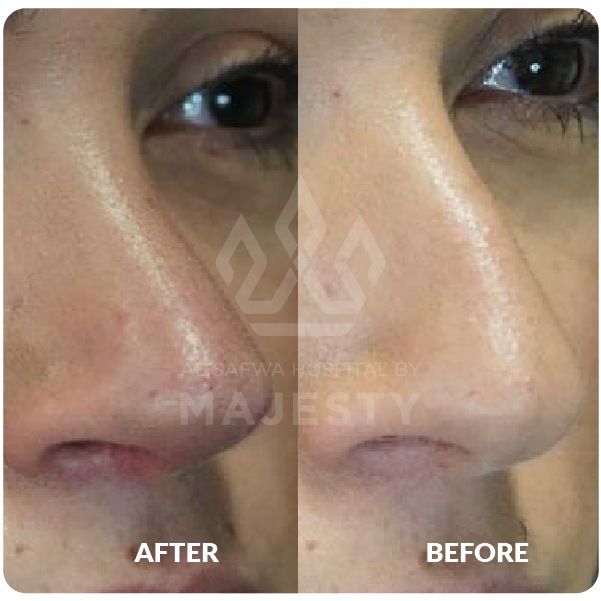 تجميل الأنف