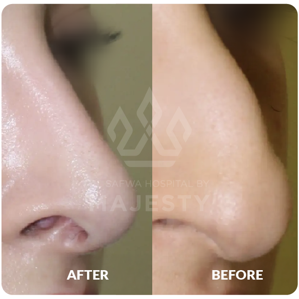 عملية تجميل الأنف
