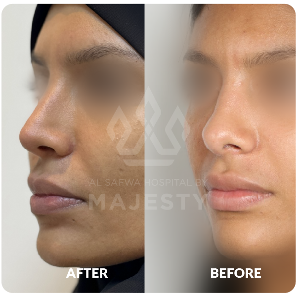 عملية تجميل الأنف