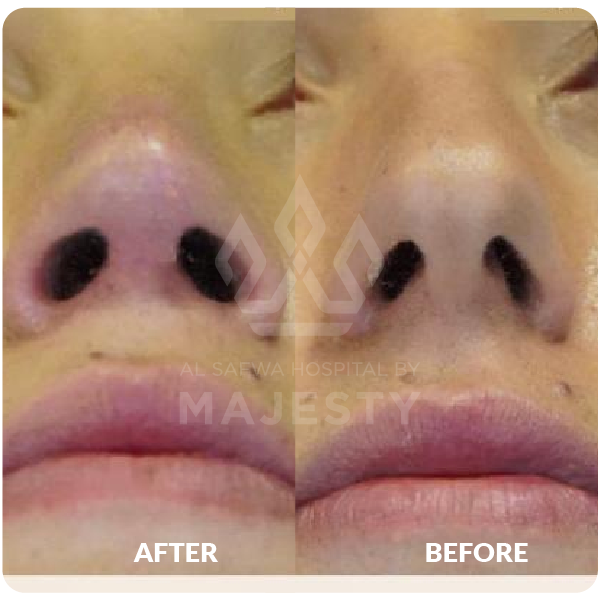 تجميل الأنف