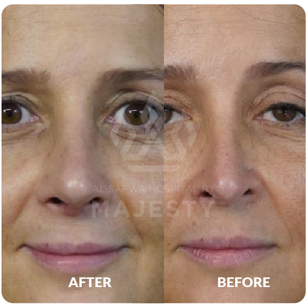 تجميل الأنف