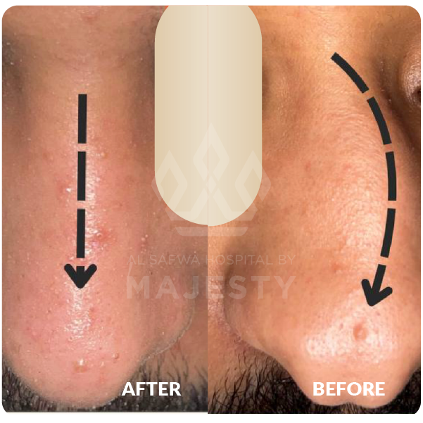 تجميل الأنف